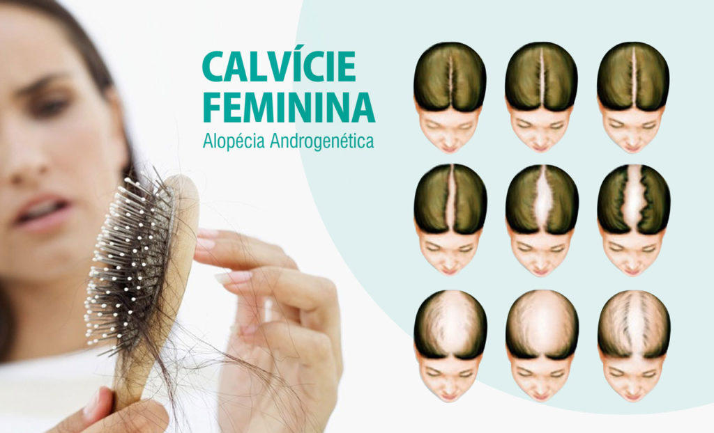 Infográfico ilustrando a calvice feminina, por dermatologista especialista em cabelo.