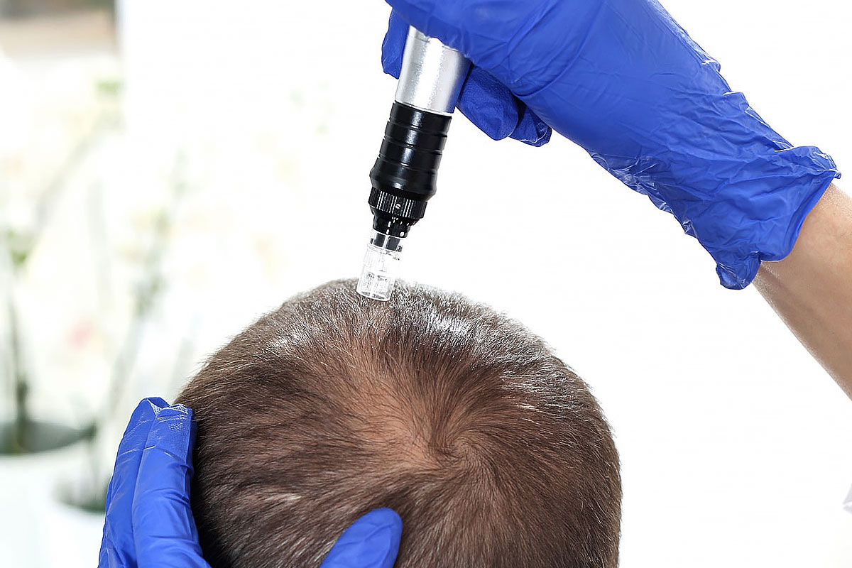 Microagulhamento capilar: Saiba como funciona essa técnica e suas